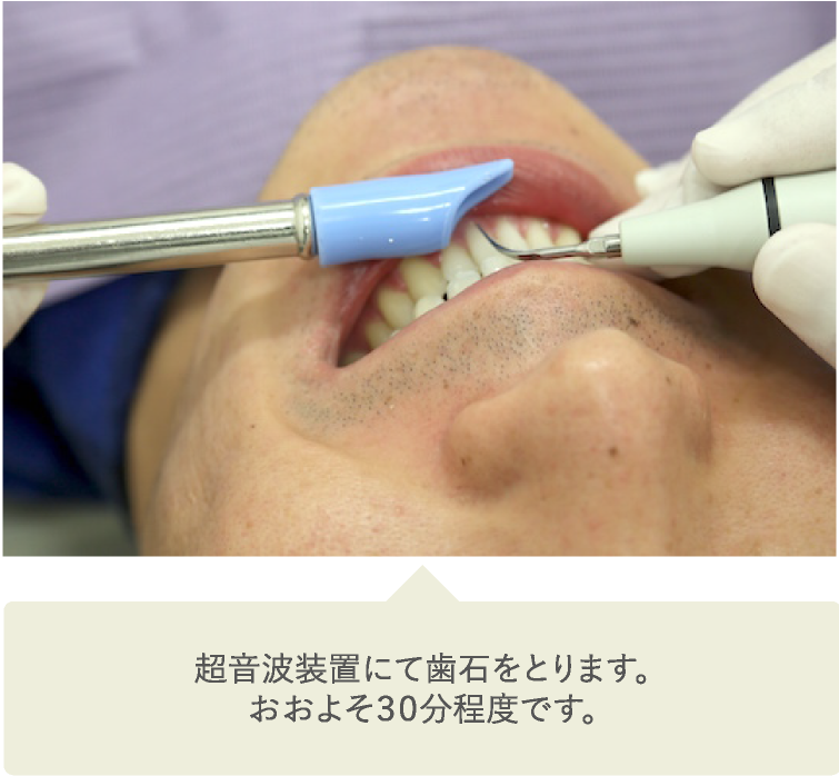 超音波装置にて歯石をとります。おおよそ30分程度です。