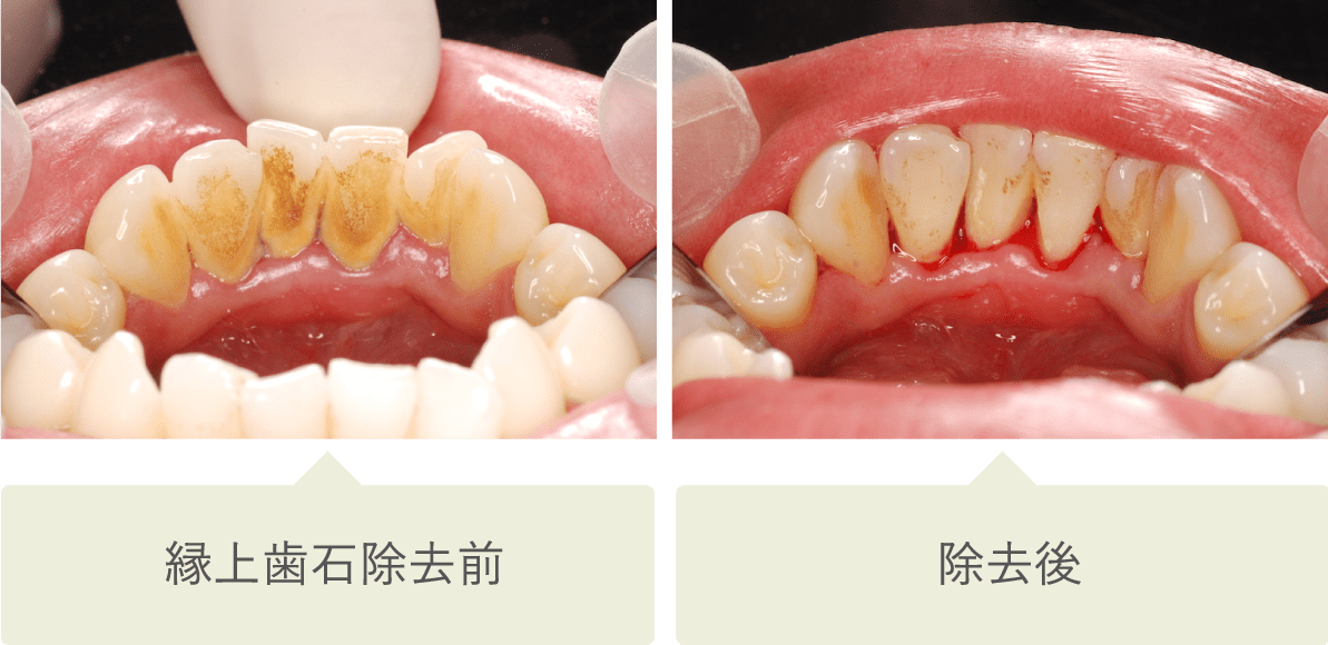 縁上歯石除去前・除去後