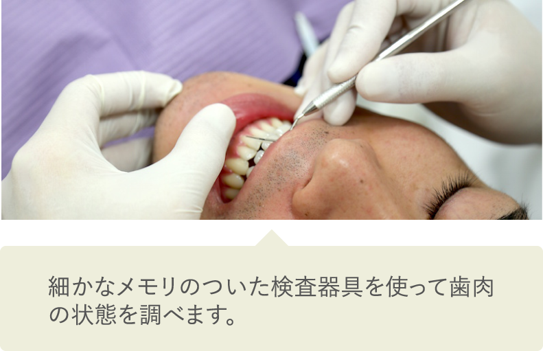 細かなメモリのついた検査器具を使って歯肉の状態を調べます。