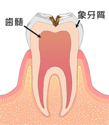 象牙質内のむし歯