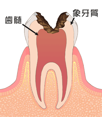 歯髄に達するむし歯３