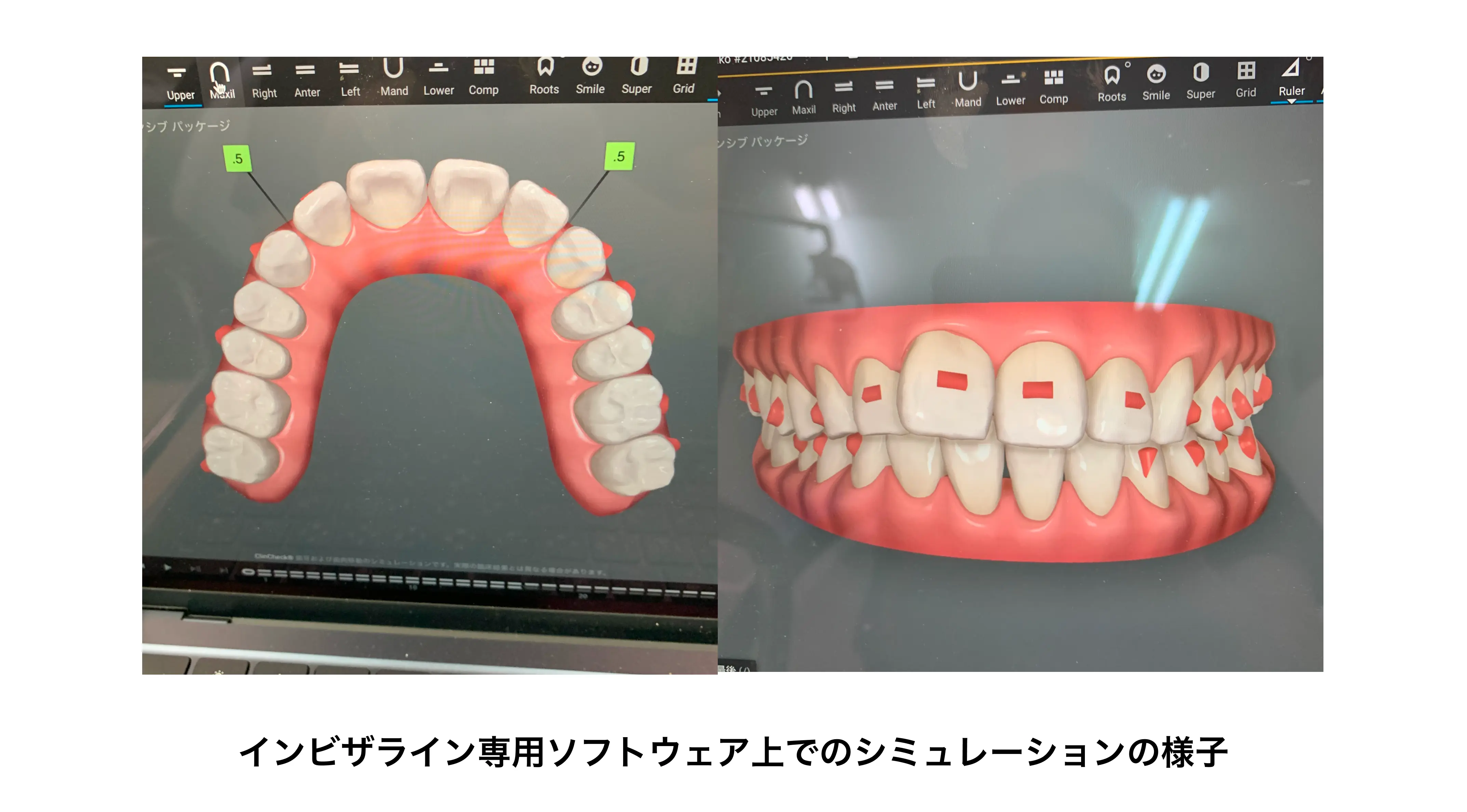 インビザラインのシミュレーションの様子