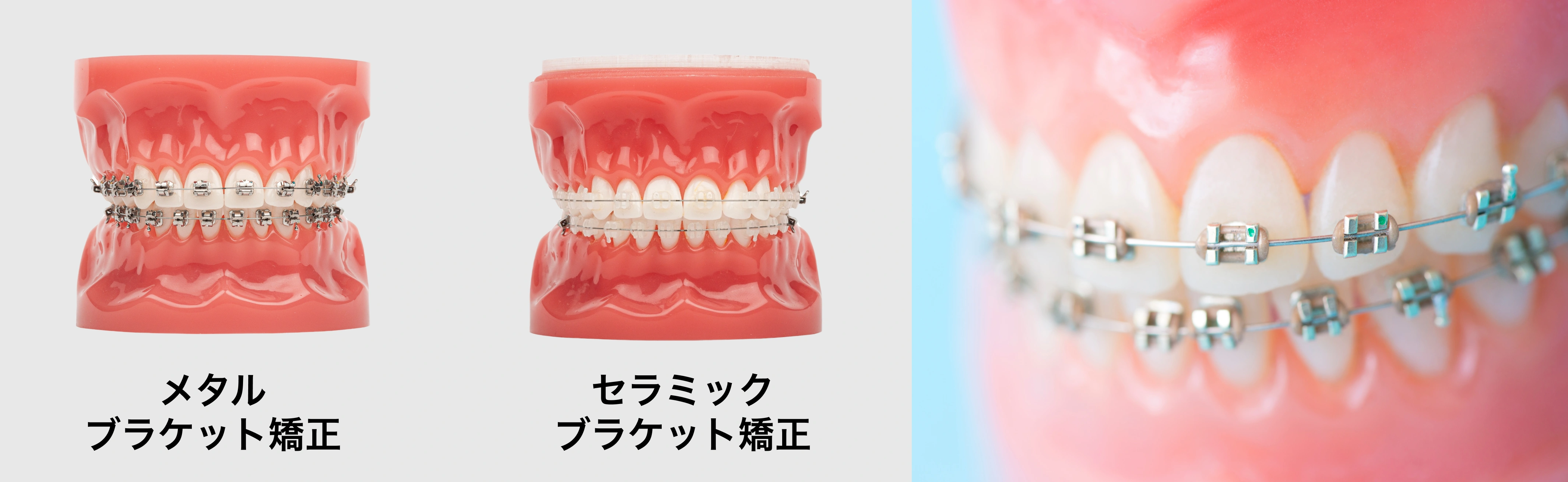 メタルブラケット・セラミックブラケット矯正装置