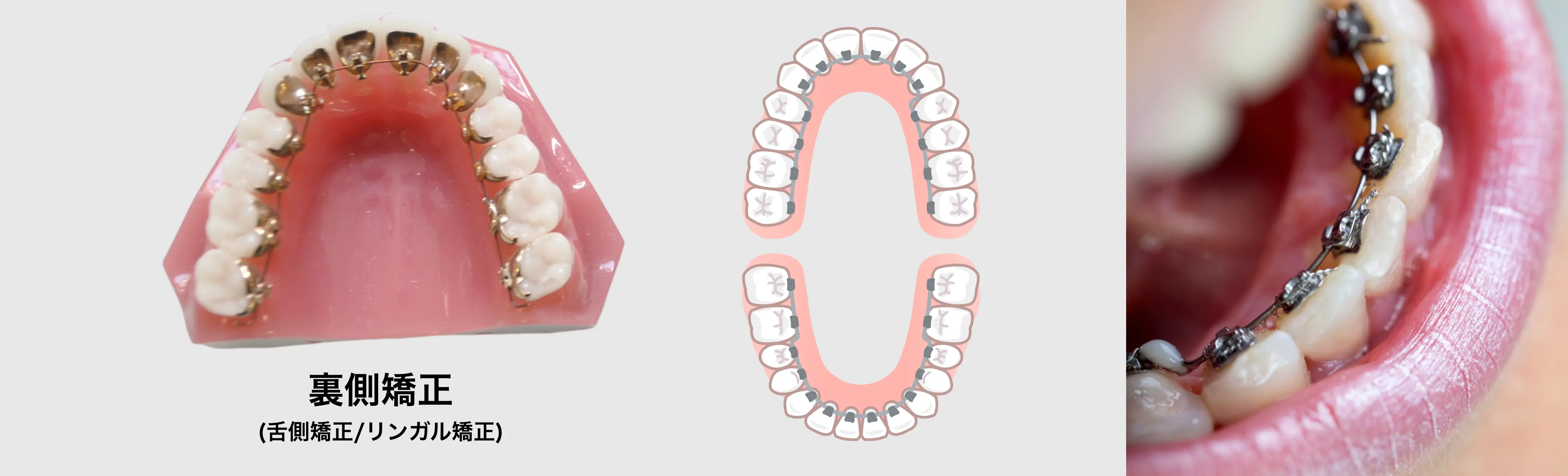 裏側矯正装置(裏側矯正・リンガル矯正)
