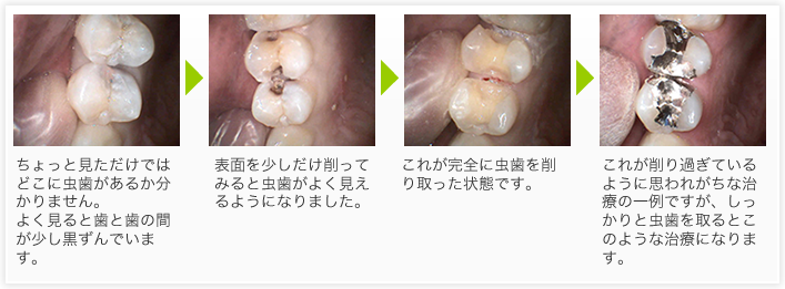 川越の歯科、本川越歯科の保険でできる白い詰め物インレーの症例
