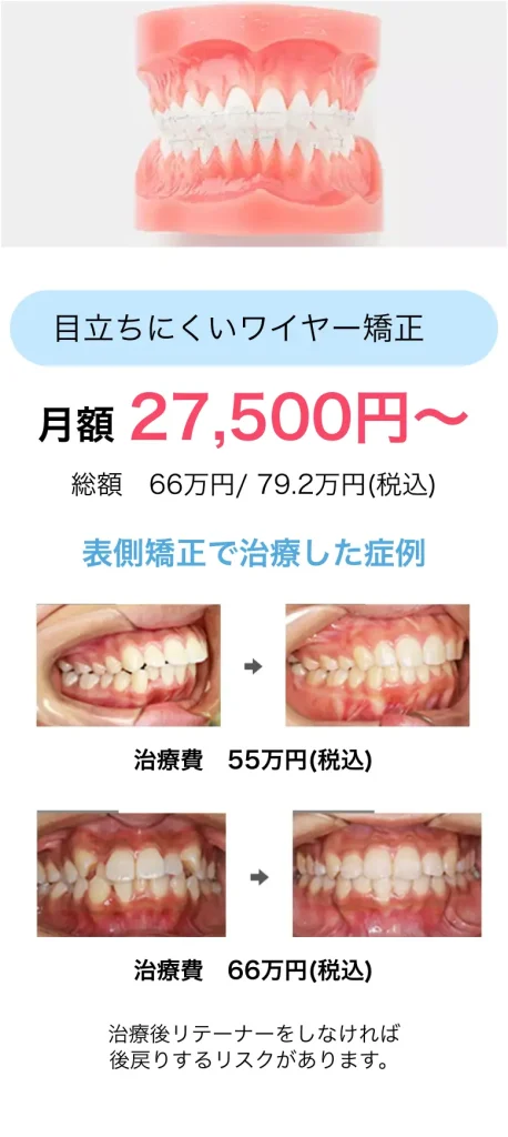 目立ちにくいワイヤー矯正/月額27、500円〜(総額66万円〜税込)