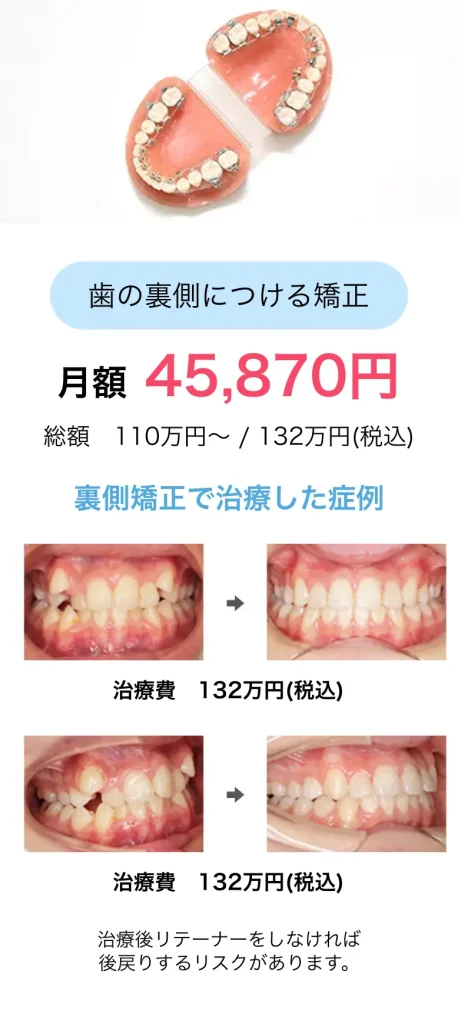 歯の裏側につける矯正月額45,870円(総額110万円〜税込)