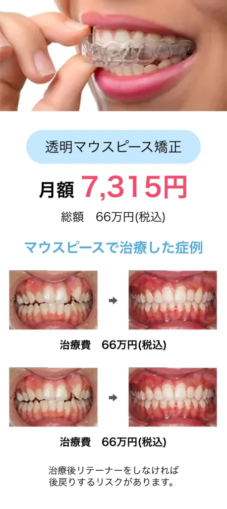 透明マウスピース矯正(インビザライン)月額7315円(総額66万円)